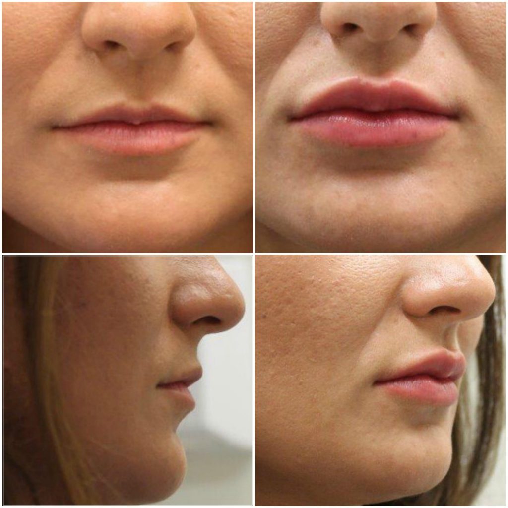 aumento labios 1