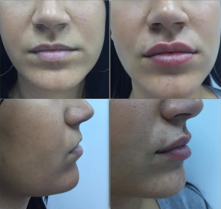 aumento labios 2b