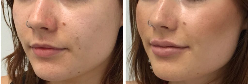 Resultados de tratamiento de aumento de labios con ácido hialurónico. Antes y después.