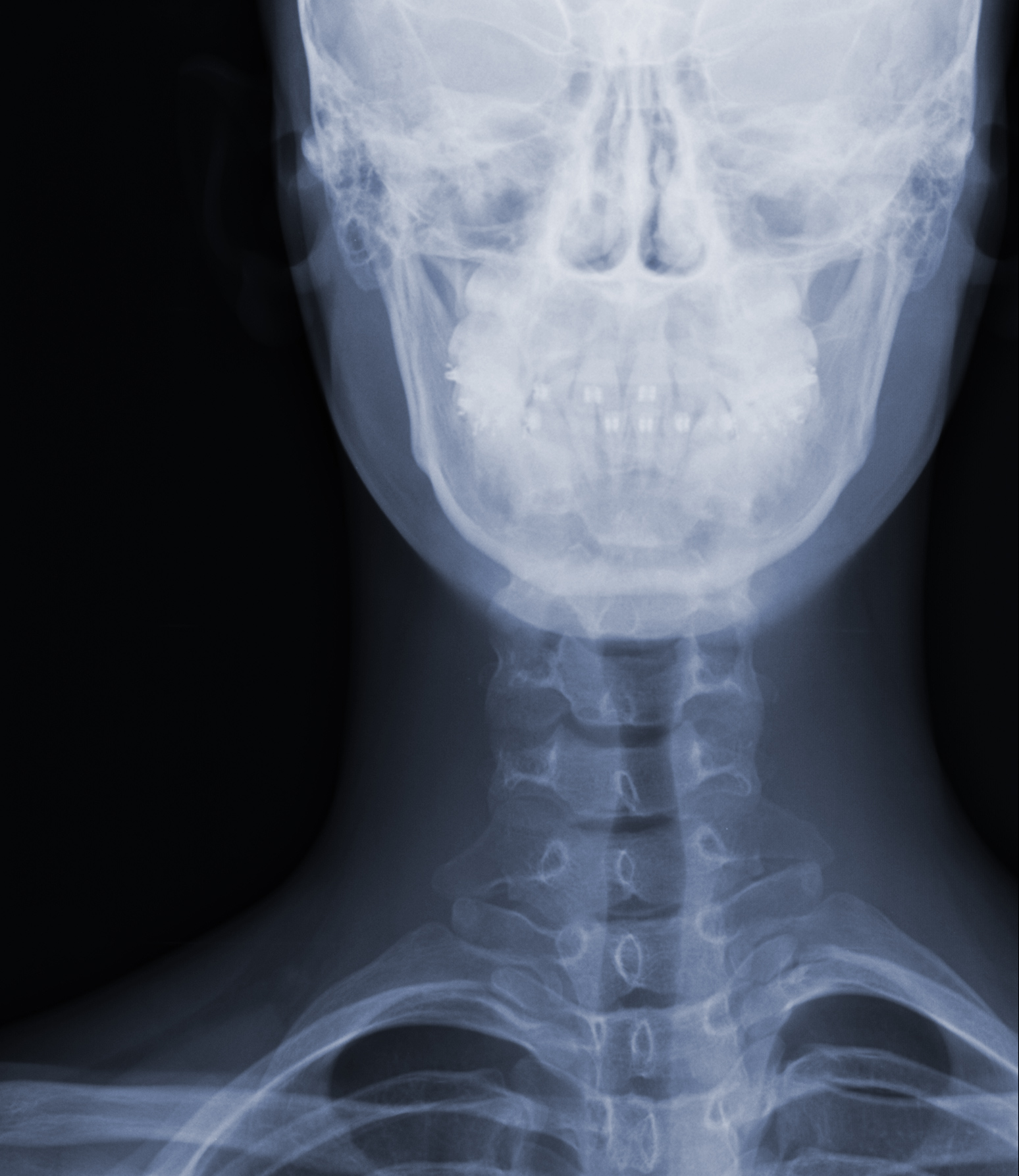 Radiografía de cervicales - Clínica Magnasalud (Valencia)