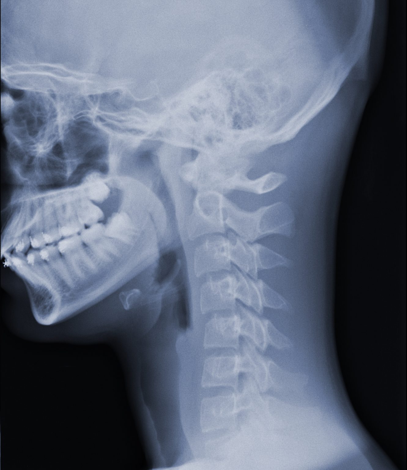 Cuello Rigido Radiografía de cervicales - Clínica Magnasalud (Valencia)